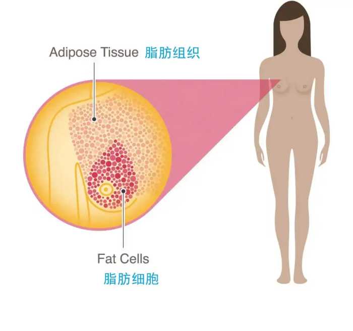 37岁，她切掉了自己的双乳：3分钟自检，学会了能救命